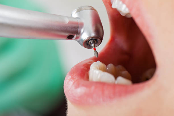 Best Emergency Dental Extractions in Duquesne, MO